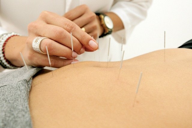 Acupuntura Solidária: ação oferece alternativa de tratamento para dor 