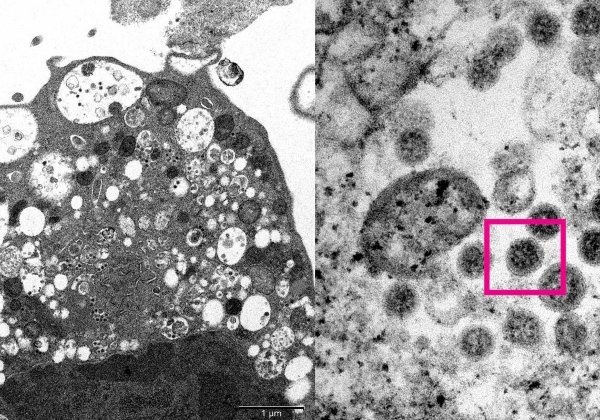 Risco de internação da Ômicron é menor do que Delta, diz estudo
