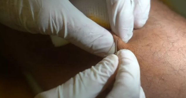 Dois meses após atentado, Danilo Fernandes ainda retira vidro do corpo