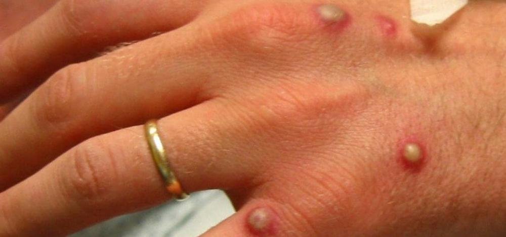 Infectados com a varíola do macaco podem transmitir doença por quatro semanas, diz especialista