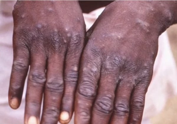 OMS espera identificar mais casos de varíola dos macacos