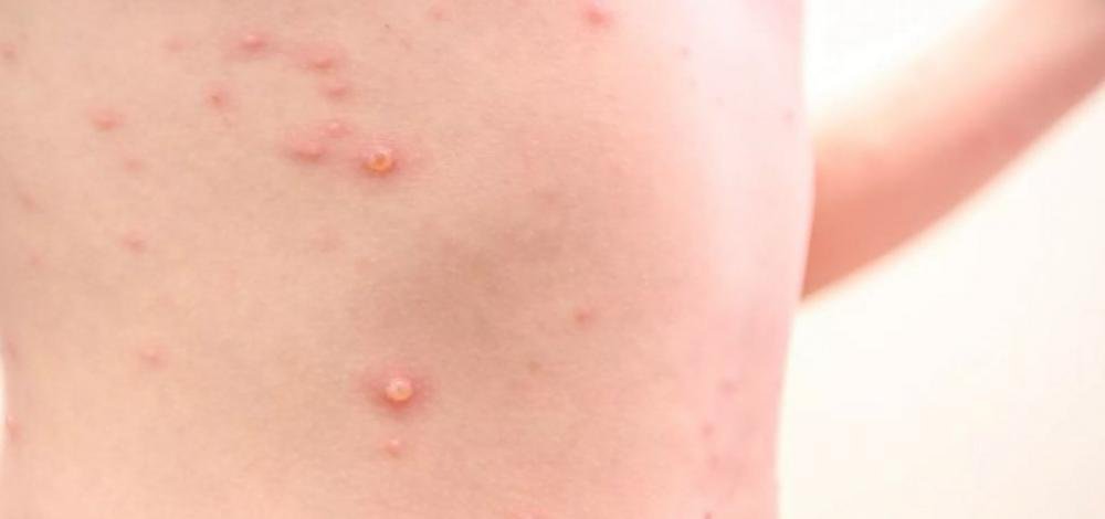 São Paulo confirma primeiro caso de varíola dos macacos no Brasil