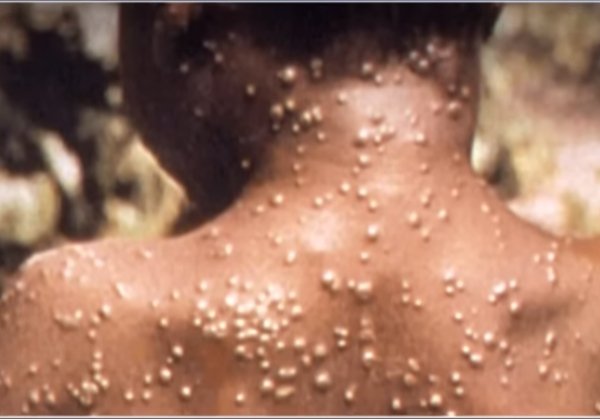 Rio de Janeiro registra primeiro caso de varíola dos macacos na cidade