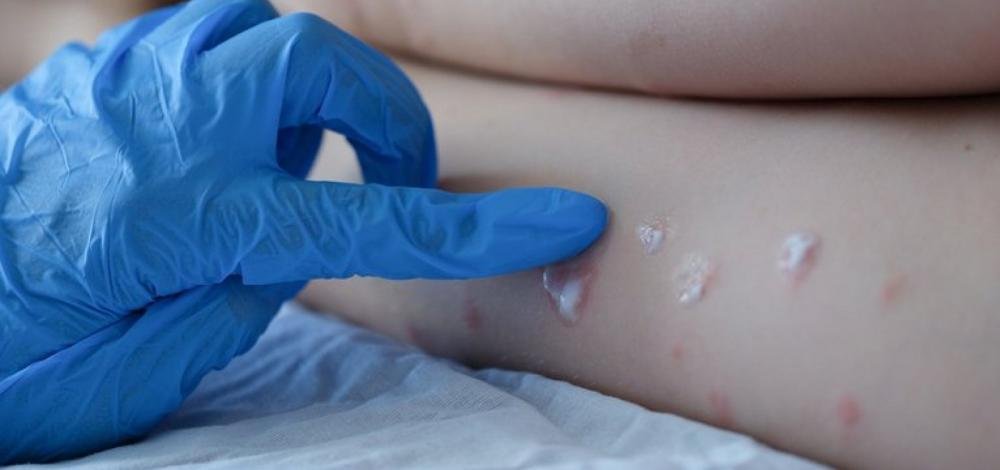 Brasil tem 21 casos confirmados de varíola dos macacos e 28 em investigação