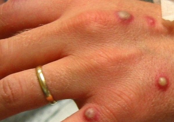 Segundo caso de varíola do macaco é confirmado em Salvador