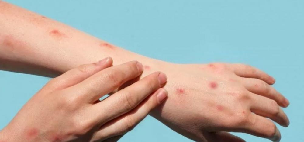 Bahia chega a 30 casos de varíola dos macacos