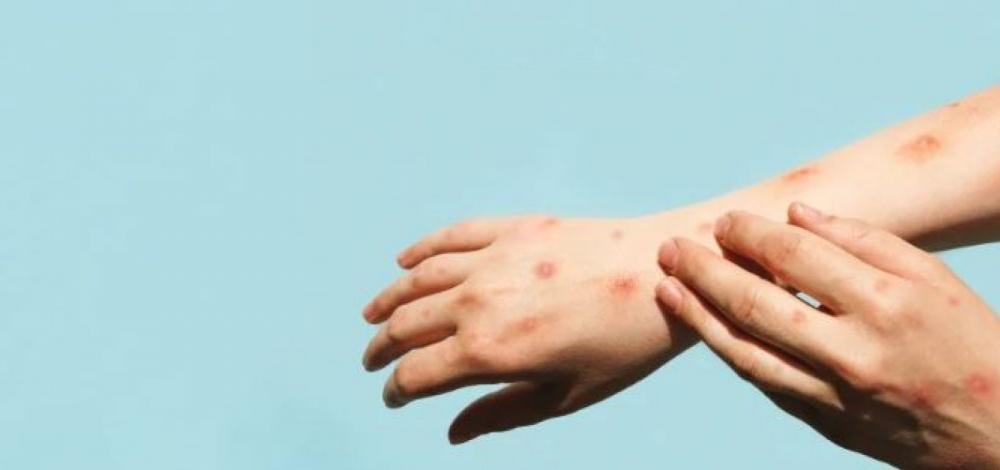 Bahia confirma dois novos casos de varíola dos macacos e totaliza 55 contaminações