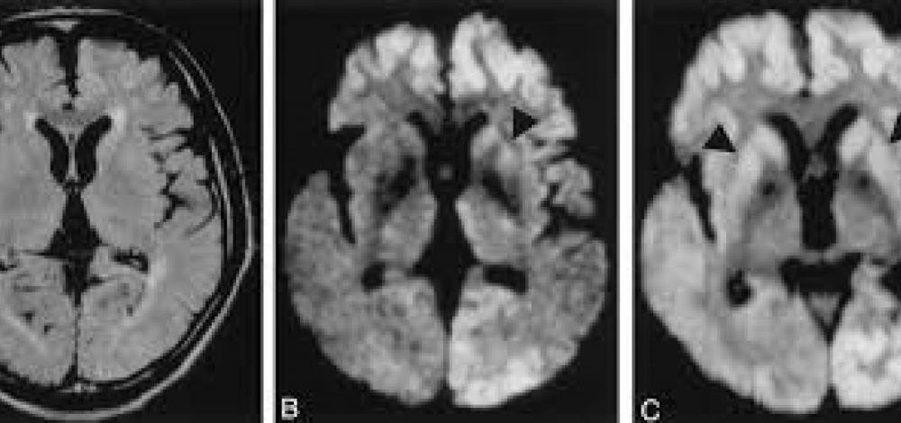 Salvador contabiliza terceiro óbito decorrente da Doença de Creutzfeldt-Jakob