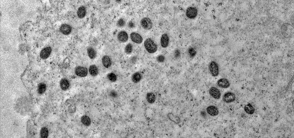 Varíola dos macacos: Bahia registra 123 casos de pessoas infectadas pela doença