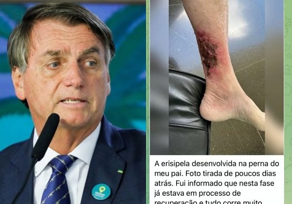 Carlos Bolsonaro publica foto da perna do presidente com erisipela
