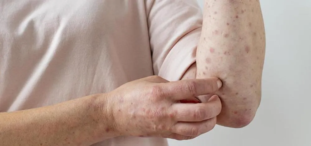 Mpox não é nova Covid, tranquiliza autoridade da OMS