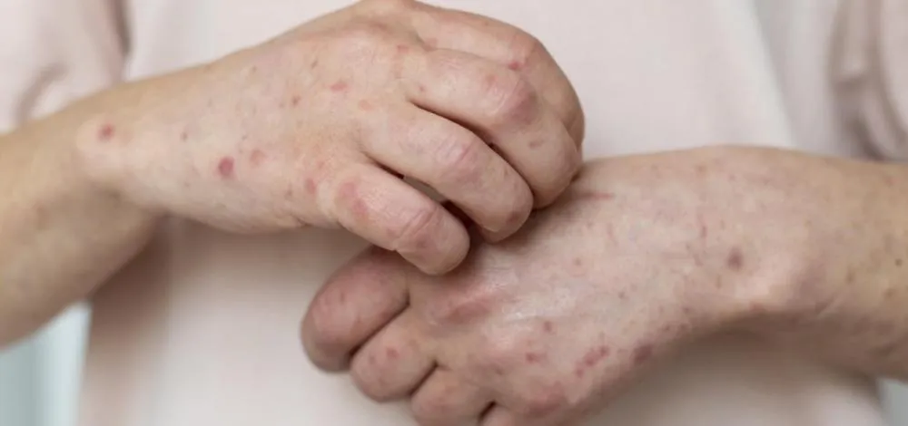 Bahia investiga novo caso suspeito de Mpox