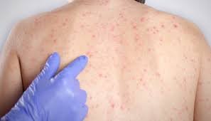 Bahia reforça importância da prevenção ao sarampo