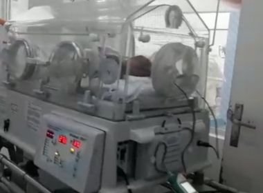 SAJ: Gêmeas siamesas são levadas para hospital referência em cirurgia de separação