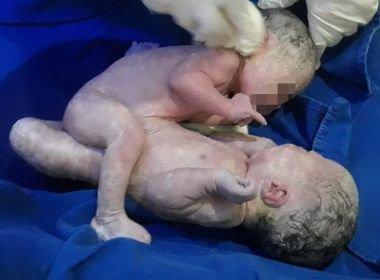 Gêmeas siamesas de SAJ devem ser separadas após um ano, explica médico de Goiás