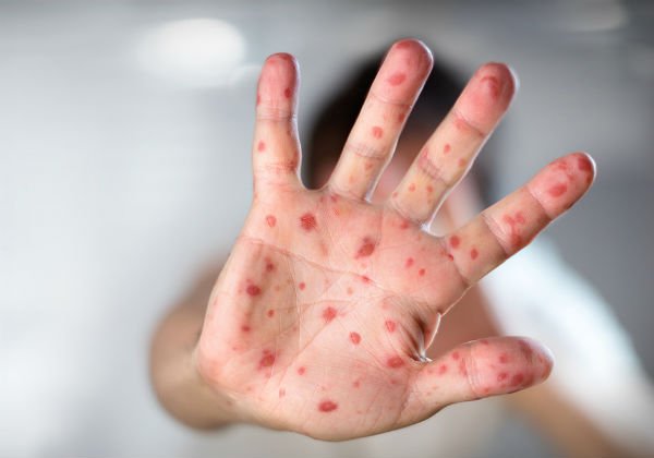 Número de casos confirmados de sarampo sobe para 4.507 no Brasil