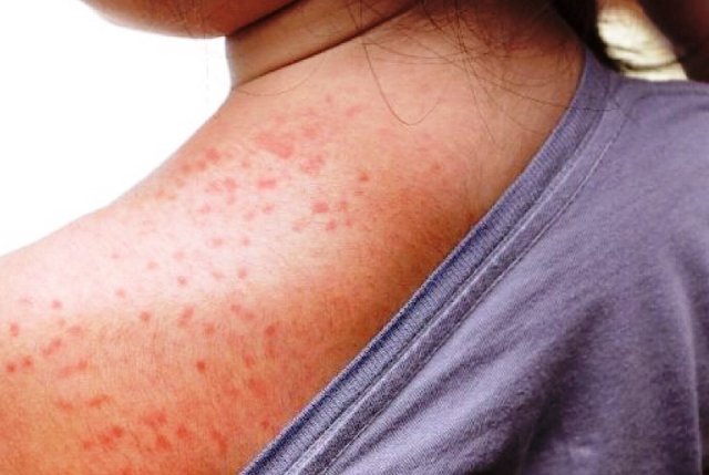 Bahia registra oito casos novos de sarampo nas cidades de Santo Amaro e Jacobina