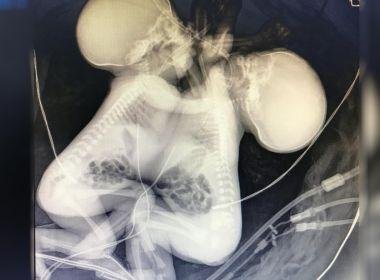 Gêmeas siamesas baianas morrem em hospital de Goiânia