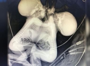 Casos recentes de gêmeos siameses em SAJ podem estar ligados a qualidade da água e solo