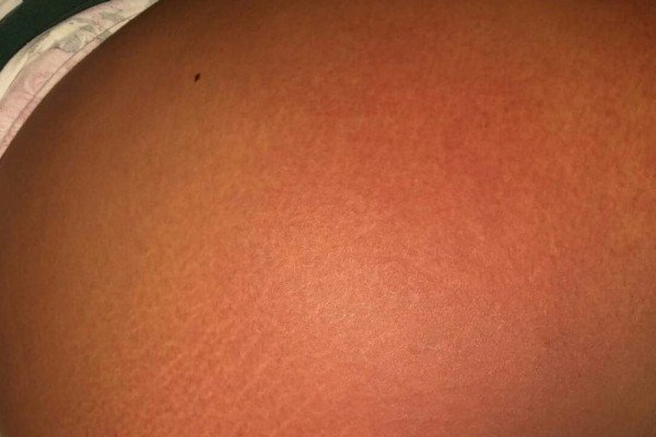 Professora relata mal estar após contato com manchas de óleo na praia de Itapuã