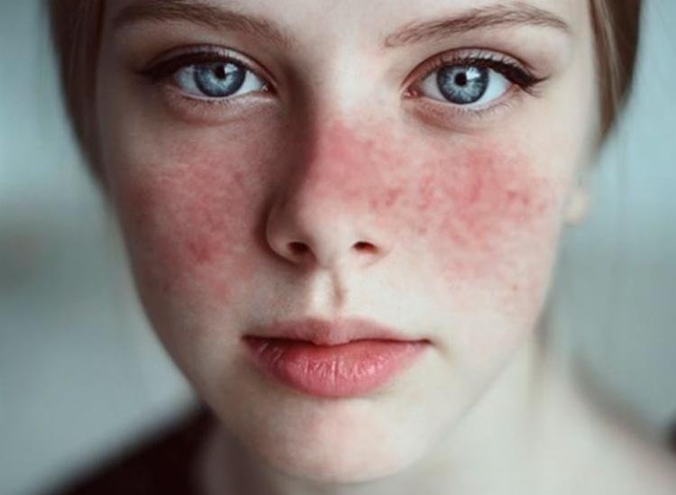 Lúpus: Bahia registra 7.458 pessoas internadas com doença